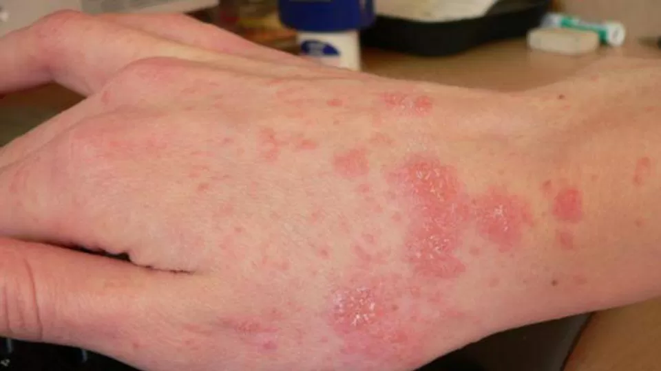 Cuidado al compartir ropa usada sin desinfectar, puede originar "sarna" en el ser humano