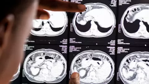 EVC en méxico: alertan sobre la detección temprana para salvar vidas y reducir secuelas