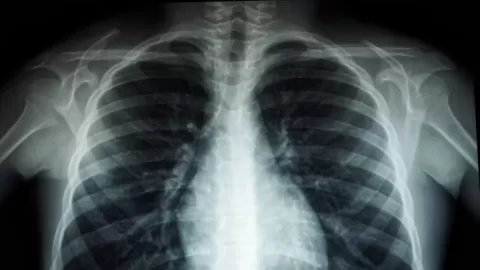 Alerta sanitaria en México: Salud advierte por un repunte significativo de tosferina en 2025