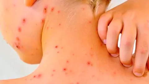 Sarampión en México: Un Solo Contagio Puede Desatar una Epidemia; Urgente Llamado a la Vacunación Ante Más de 7,000 Casos y 24 Muertes