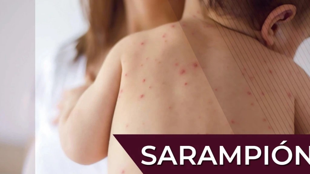 Sarampión: OPS Declara Riesgo 'Muy Alto' en América tras Triplicarse Casos y Mortandad