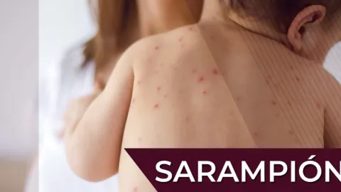 Sarampión: OPS Declara Riesgo 'Muy Alto' en América tras Triplicarse Casos y Mortandad