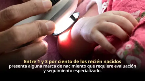 Entre 1 y 3 por ciento de los recién nacidos presenta alguna marca de nacimiento que requiere evaluación y seguimiento especializado