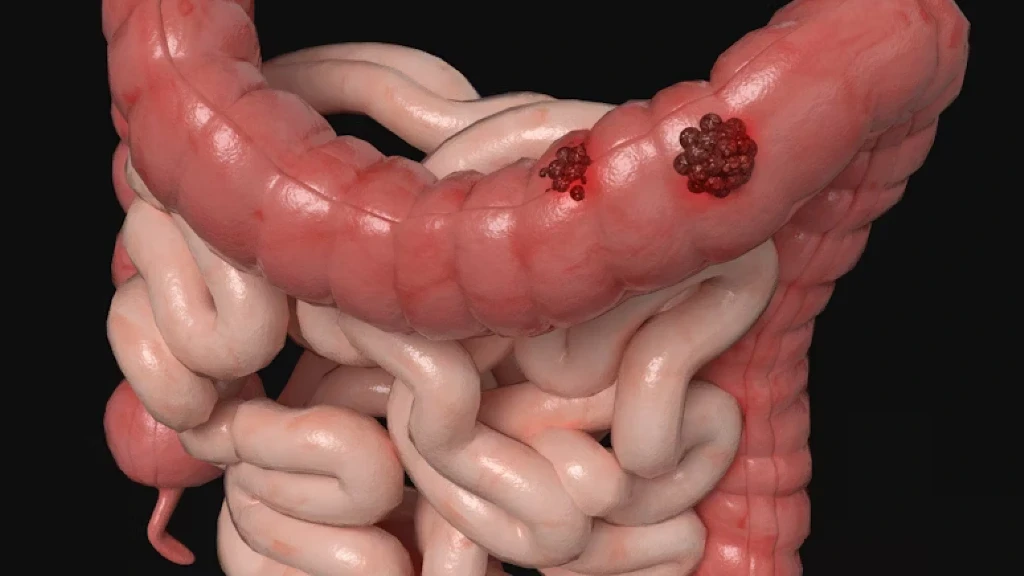 Impactante: 1 de cada 8 Tumores Atribuible a Infecciones Prevenibles, Revela Estudio